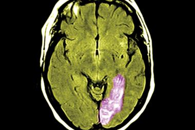 Stroke and other CV admission rates were lower with high HDL levels (Photograph: SPL)