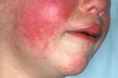 Scarlet fever presents with an erythematous, blanching rash which spreads over the body after 12-24 hours