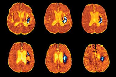 Stroke: patients with high BP faced higher risk of cardiovascular event (photo:SPL)