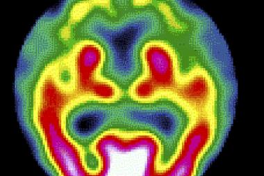 Alzheimer’s disease, as shown on a SPECT brain scan (Photograph: SPL) 