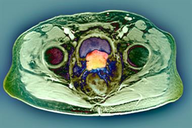 Coloured axial MRI scan of a patient with prostate cancer (Photograph: SPL)