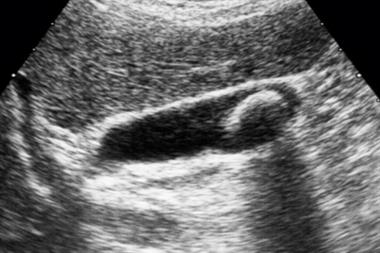Ultrasound is the most common diagnostic tool used; it can identify the number and size of stones (Photograph: SPL)
