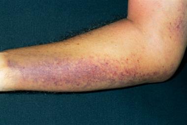 Signs and symptoms can reflect any point in the spectrum between bleeding and thrombosis (Photograph: SPL)