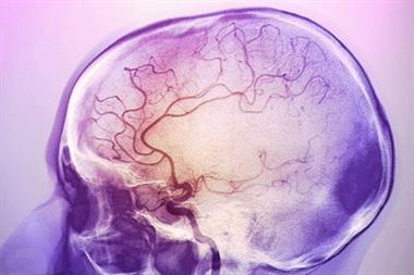 Stroke: increased risk due to migraine calculated for the first time (Photograph: SPL)