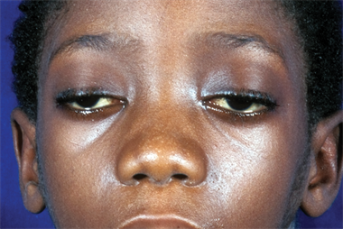 Patient with signs of upper eyelid and facial weakness (Photograph: SPL)