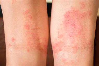 Atopic dermatitis in the folds of elbows