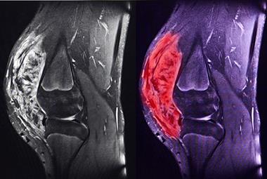 Improving diagnosis and prognosis for sarcoma cancer patients
