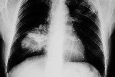 Frontal chest X-ray of the lungs of an 83-year-old patient with small cell lung cancer (Photograph: SPL)