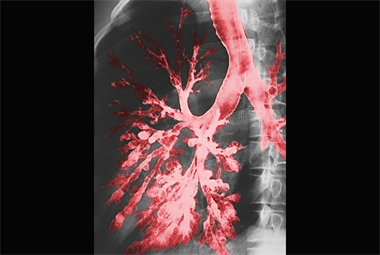 Red flag symptoms: Haemoptysis