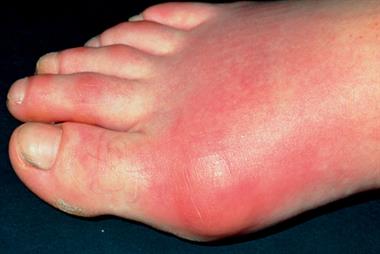 Inflamed toe joint in patient with gout (Photo: SPL)