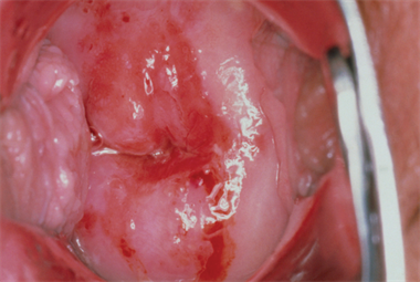 Postcoital bleeding - red flag symptoms
