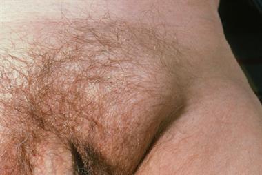 Red flag symptoms - Groin swelling