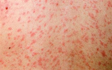 Measles rash is erythematous and maculopapular