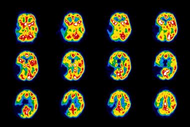 Stroke: coloured PET scan of a stroke patient's brain (Photo: Science Photo Library)