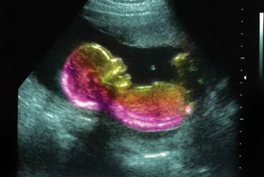 Foetus at 20 weeks (Photo: Josh Sher/Science Photo Library)