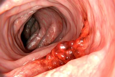 Computer illustration of a malignant tumour in the colon