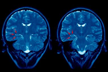 A brain MRI of an epilepsy patient: researchers called for GPSI-led services to plug gaps in care (Photo: SPL)