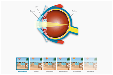 Understanding how eye conditions affect patients' sight