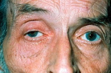 Red flag symptoms: Diplopia