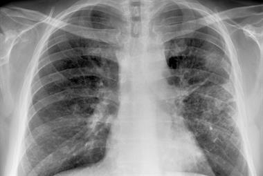 Lung cancer: X-rays often miss tumours (photo: SPL)