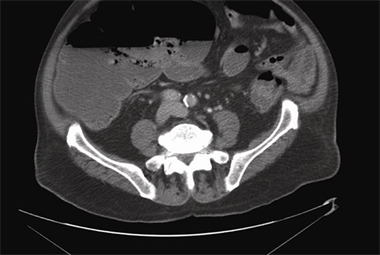 CT scan showing toxic megacolon requiring surgery (Author image)