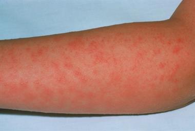 Scarlet fever cases are at their highest level since 1990 (photo: SPL)