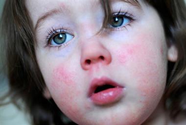 Scarlet fever: season's record levels may be on the decline (photo: iStock)