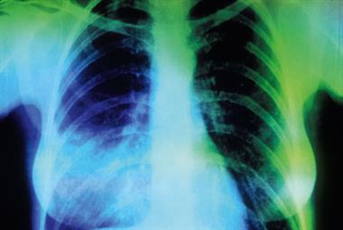 Red flag symptoms: Respiratory tract infections