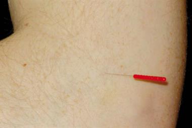 Acupuncture: controversy continues over its benefits for IVF patients 