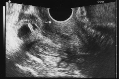 Ultrasound findings that suggest ectopic pregnancy