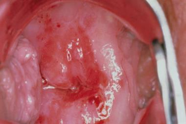 Hpv urethra symptoms, Hpv warts urethra - Debutul giardiei