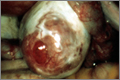 Laparoscopic view of ovualtion
