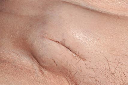 Lymphadenopathy in the groin may be a sign of malignancy