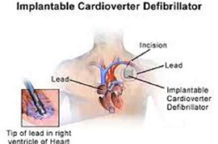 Medtronic defibrillators lack authentication leaving them open to attack