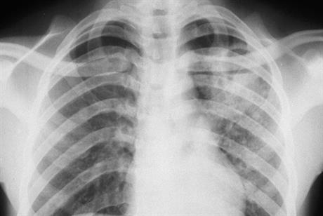 Tuberculosis: NICE guidance | GPonline