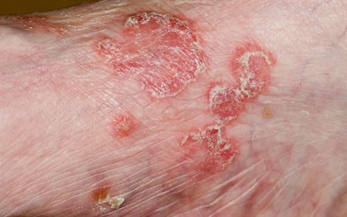 Brodalumab: a new biologic for moderate-to-severe plaque psoriasis ...