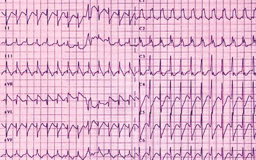 Cardiac warning for anticholinergic injection | MIMS online