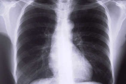 Asbestos hazard warning: British Lung Foundation