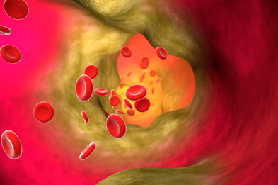 Computer artwork of blood cells (round) in an artery affected by atherosclerosis. | SPL