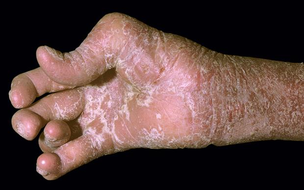 NICE approves further treatment options for psoriatic NICE approves further treatment options for psoriatic