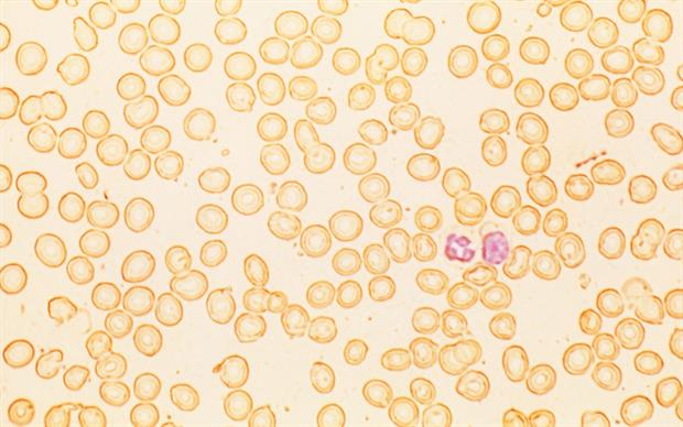Iron deficiency is common in the later stages of CKD as a result of decreased renal synthesis of erythropoieses | SCIENCE PHOTO LIBRARY