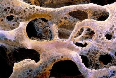 Administration of parathyroid hormone in postmenopausal women with osteoporosis (pictured) has been shown to reduce the risk of fracture | SCIENCE PHOTO LIBRARY