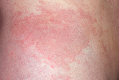 Xolair (omalizumab) a new treatment for chronic spontaneous urticaria