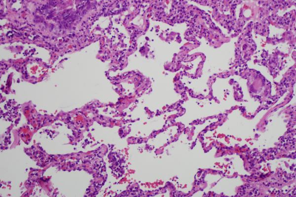 Health - damaged lung - Photograph: Mutleysmith CC BY-SA 3.0