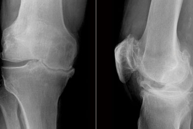 Osteoarthritis Clinical Review Gponline - 