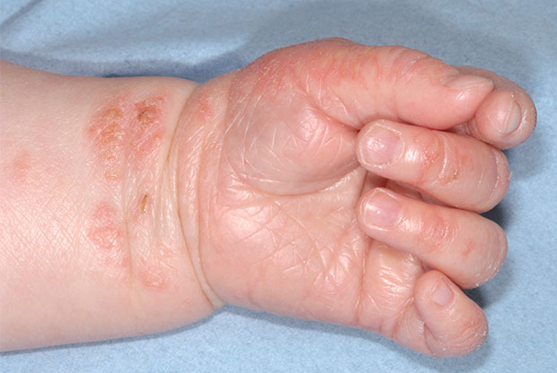 Résultat de l'image pour l'eczéma atopique
