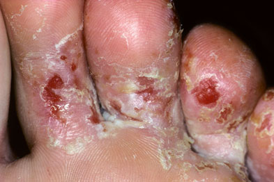 pictorial case study a fungal foot infection gponline