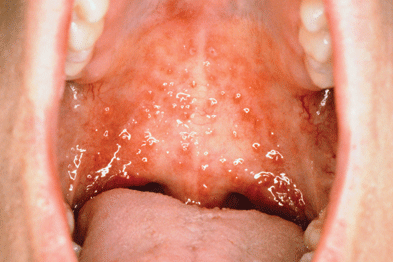 Herpes Simplex Virus Gponline