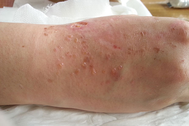 Doxycycline for skin lyme disease and alcohol