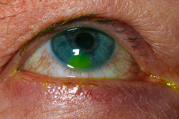 Eye Movements Reveal Temporal >> Eye Pain Red Flag Symptoms Gponline Eye Movements Reveal Temporal >> Eye Pain Red Flag Symptoms Gponline